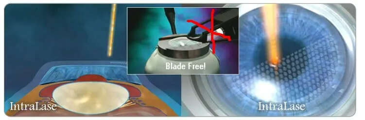 lasik- eye-surgery-process-Advanced Technology